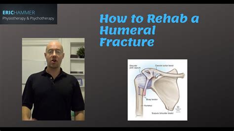 How To Rehab A Humeral Fracture Youtube