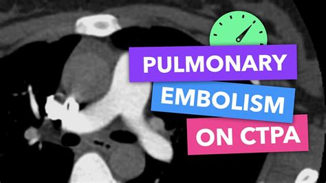 Pulmonary Embolism On Ctpa Radiopaedia S Emergency Radiology Course Youtube