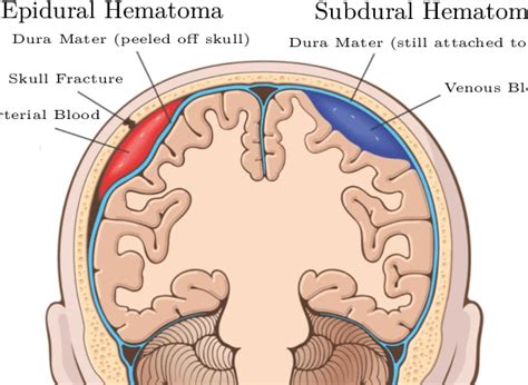 Epidural Vs Subdural Hematoma Mnemonic Diagram Of Subdural Hematoma