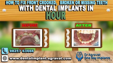 However, braces are generally better for crooked teeth. How to Fix Crooked Front Teeth without Braces also Broken or Missing Teeth with Dental Implants ...