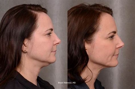 Thermismooth For Facial Jowls Before And After Facial Cosmetic Surgery Plastic And
