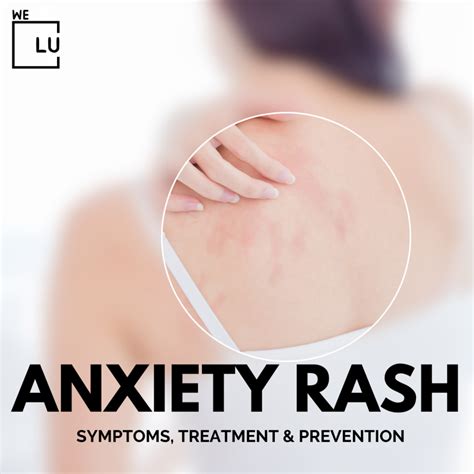 Anxiety Rash Symptoms Causes Treatment And Prevention