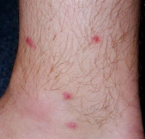 Red Spots On Legs Pictures Symptoms Causes Treatment Diseases
