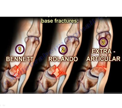 Thumb Metacarpal Base Fracture —