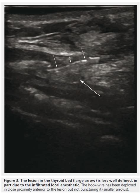 Application Of Ultrasound Guided Wire Placement In Head And Neck Cancer