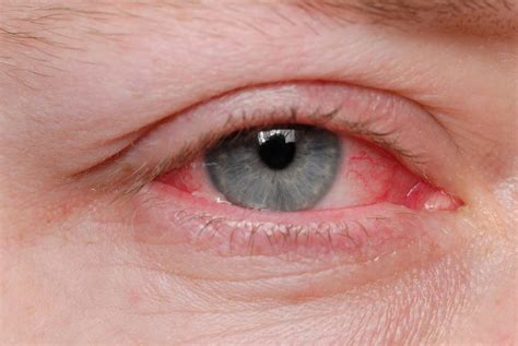 Increased Conjunctivitis Risk Observed In Patients Initiated Dupilumab