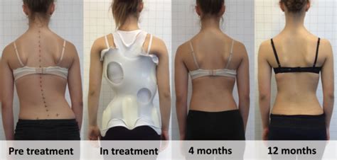 Scoliosis Bracing Huntington Chiropractors Waterfront Chiropractic