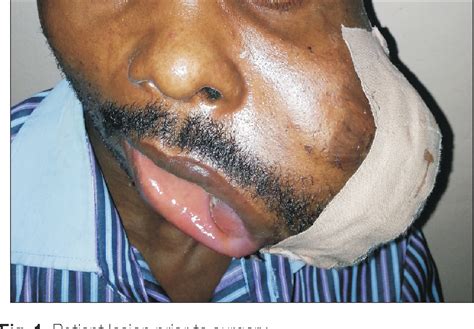 Figure 1 From Primary Oral Soft Tissue Angiosarcoma Of The Cheek A