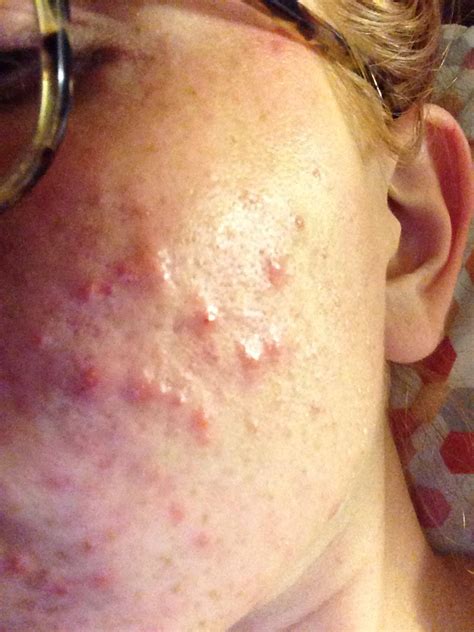 Help Cheek Acne That Wont Go Away General Acne Discussion