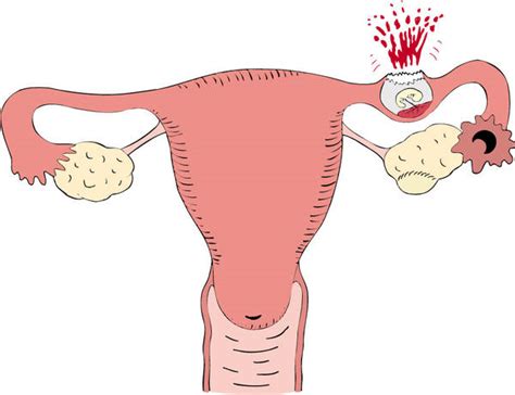 Embarazo Ectopico Sintomas Sintomas Del Embarazo Ectopico Causas