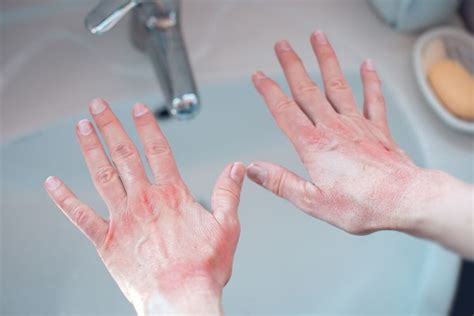 Hand Rashes Due To Handwashing 5 Possible Causes