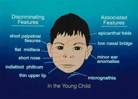About 60% of individuals with down syndrome (also known as trisomy 21) have. Flat Nasal Bridge And Epicanthal Folds : Down Syndrome ...