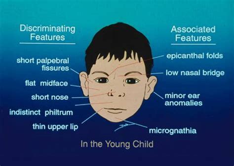 Broad nasal bridge & epicanthal folds symptom checker: Flat Nasal Bridge And Epicanthal Folds : Down Syndrome Amboss - yoursjuliette