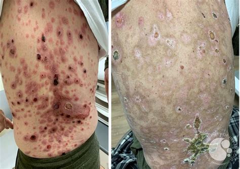 Total Skin Electron Therapy And Cutaneous T Cell Lymphoma