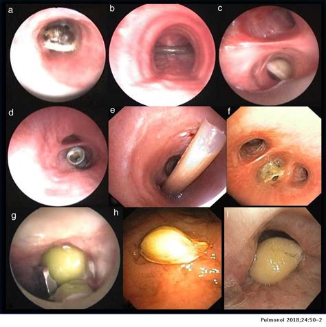 Role Of Bronchoscopy In Foreign Body Aspiration Management In Adults A
