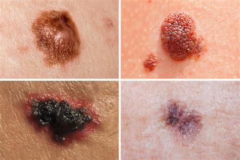 Benign Nevus Vs Melanoma