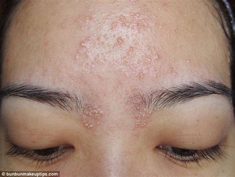 Singapore Beauty Blogger Bun Bun Suffers Horrific Skin Reaction To Spa