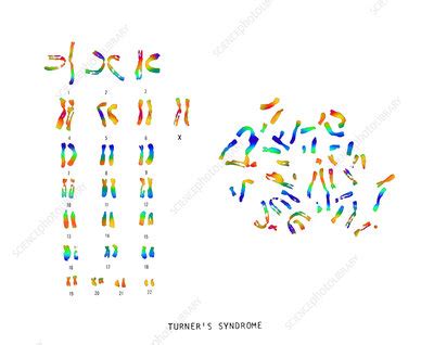 Turner S Syndrome Karyotype Stock Image C Science Photo