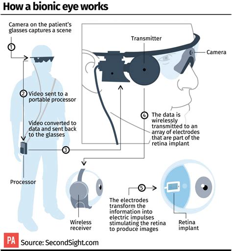 Bionic Eye Implants To Give Blind Patients Hope Of Regaining Sight Bt