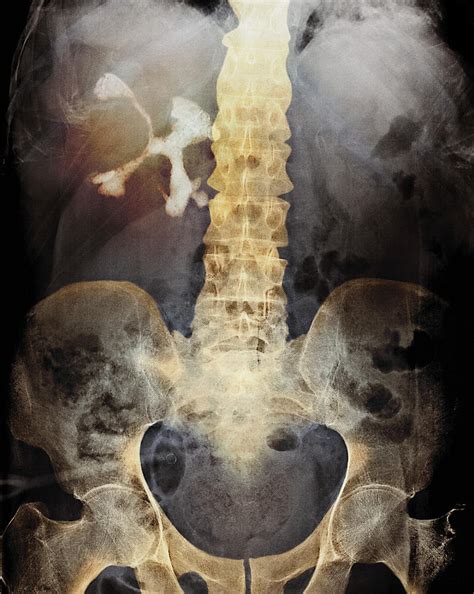 Staghorn Kidney Stone X Ray Photograph By Du Cane Medical Imaging Ltd