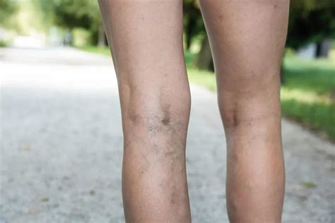 Varicose Veins Five Facts That You Should Know Midwest Institute For