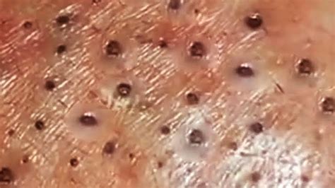 Deep Blackhead Extraction Cystic Acne And Pimple Popping 86 Youtube