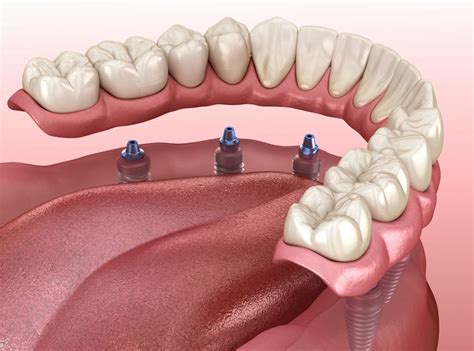 Dental Implant Overtures Dentist In Succasunna Nj