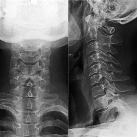 Postoperative 10 Year Follow Up Cervical Antero Posterior Lateral