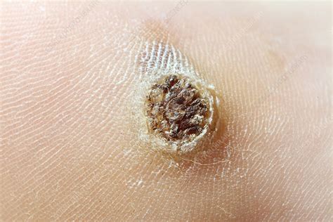 Wart Stock Image C0107505 Science Photo Library