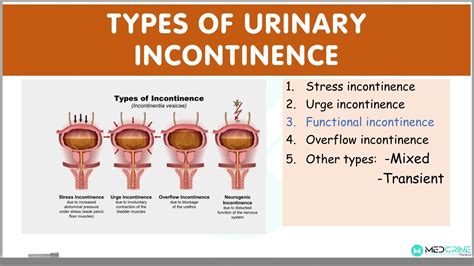 Types Of Urinary Incontinence Explained Stress Urge Functional Overflow Incontinence Youtube
