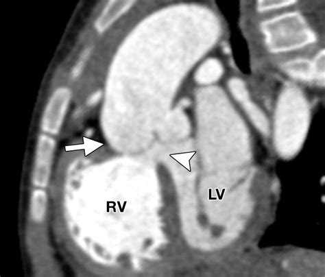 Role Of Multidetector Ct In Assessment Of Repaired Tetralogy Of Fallot
