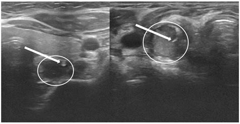 Parathyroid Tumor Ultrasound