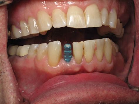 Lower Front Tooth Implants