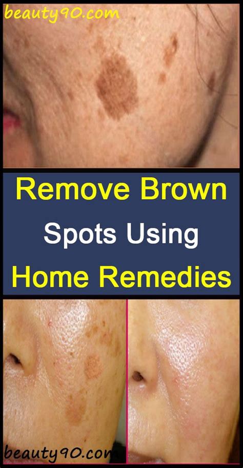 Remove Brown Spots Using Home Remedies Beauties Natural Dark Spots