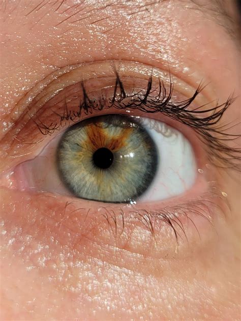 I Have A Birthmark In My Eye Its Called A Sectoral Heterochromia R