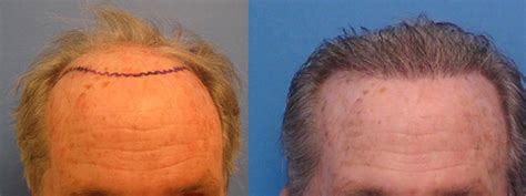 Works best on men with male pattern baldness after hair loss has stopped. Mens Before and After Hair Transplant Photos