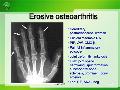 Ppt Osteoarthritis And Exercise Powerpoint Presentation Id3148420