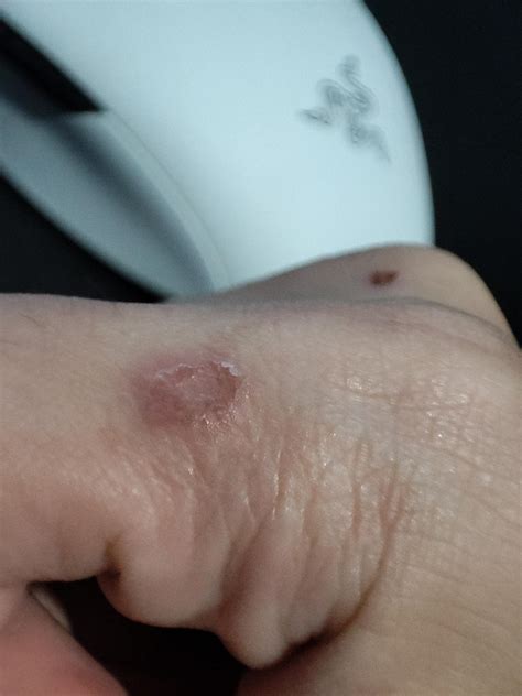 What Is This On My Hand Im Not Too Sure If It Was A Boil Before But