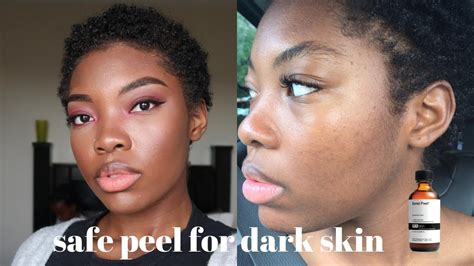 Chemical Peel At Home For Dark Skin Chemical Peel At Home For Acne