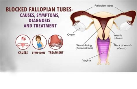 Fallopian Tube Blockage Treatment Without Surgery Dr Chanchal Sharma