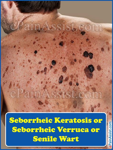 Seborrheic Keratosis Or Seborrheic Verruca Or Senile Wart Causes