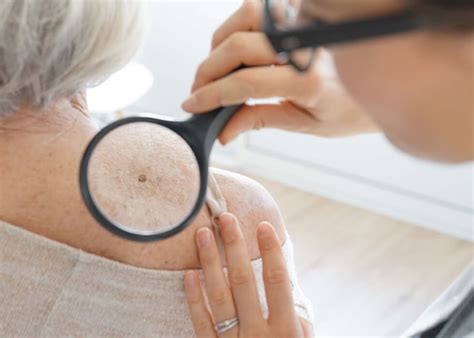 Squamous Cell Carcinoma Causestreatment Dermatology Inc