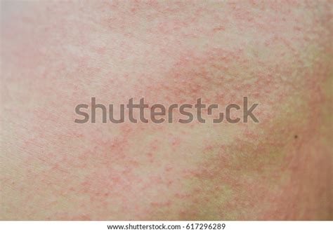 Skin Rashes Allergies Contact Dermatitis Stock Photo 617296289