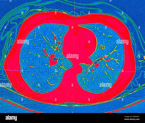Ct Scan Of Chest Axial View In Color Mode For Diagnostic Pulmonary Embolism Pe Lung Cancer