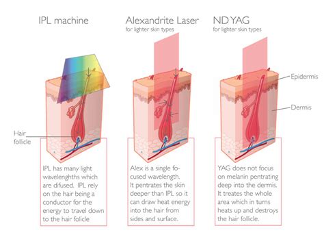 Avance permanent laser hair removal system (sdl100) $1,274.00 new. Laser Hair Removal - Parfaire Clinic