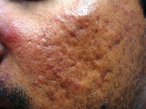 Acne Scar Medical Pictures Info Health Definitions Photos