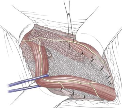 Anatomy Of Male Groin Area Pudendal Neuralgia Elecrisric