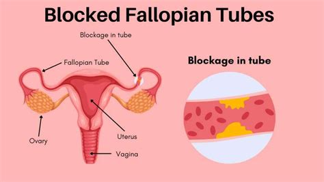 Steps To Getting Pregnant With Blocked Fallopian Tubes