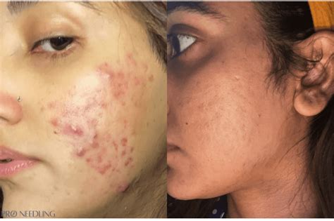 I Tried Microneedling For Acne Scars Pro Needling