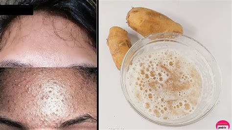 Get Rid Of Tiny Bumps On Face With Potato Home Remedies For Dark Spots